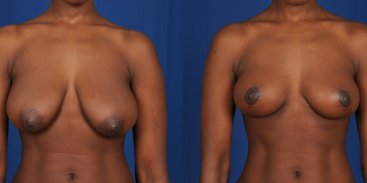 Breast Reduction And Lift 7