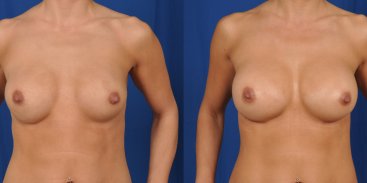 Breast Revision 1