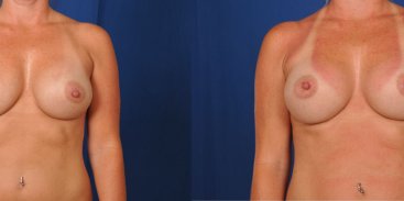 Breast Revision 2