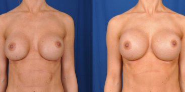 Breast Revision 6