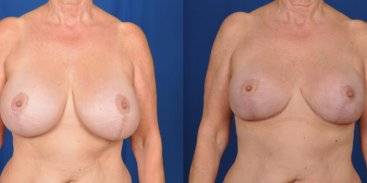 Breast Implant Replacement with Breast Lift 1