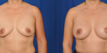 Breast Augmentation 10