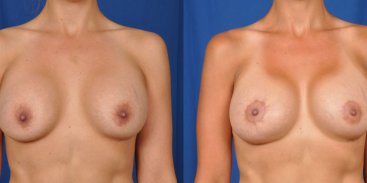Breast Implant Replacement with Breast Lift 7