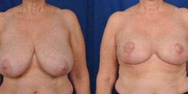 Breast Reduction and Lift 2