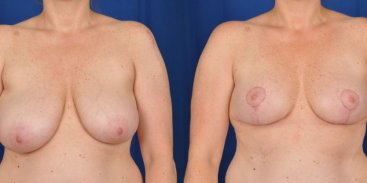 Breast Reduction and Lift 3
