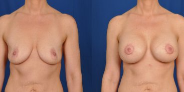 Breast Augmentation And Breast Lift 2