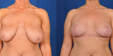 Breast Reduction and Lift 5