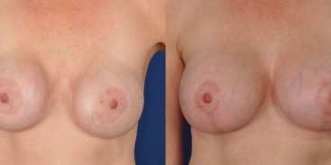 Breast Implant Replacement with Breast Lift 4