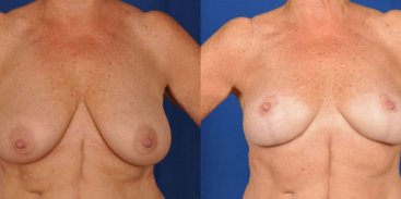 Breast Reduction and Lift 1