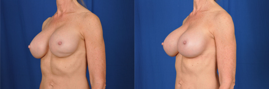 Before and after photo of a boob job revision (side view).