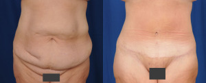 Front view of an abdominoplasty procedure results.