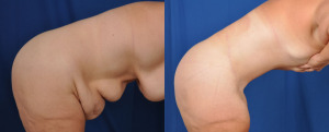 Results of an abdominoplasty procedure.