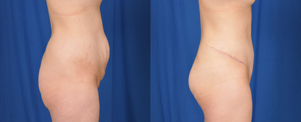 Female abdominoplasty procedure results (side view).