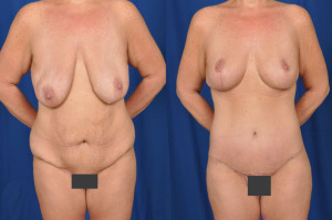 Results of an abdominoplasty combined with a breast lift operation.