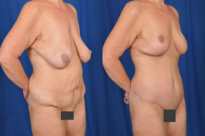 Results of an abdominoplasty combined with a breast lift.