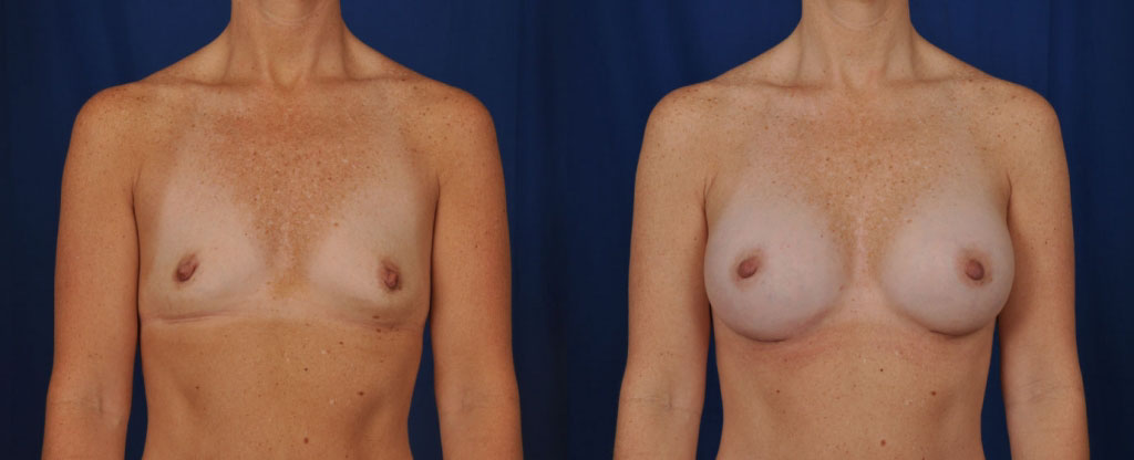 Results of a breast augmentation.