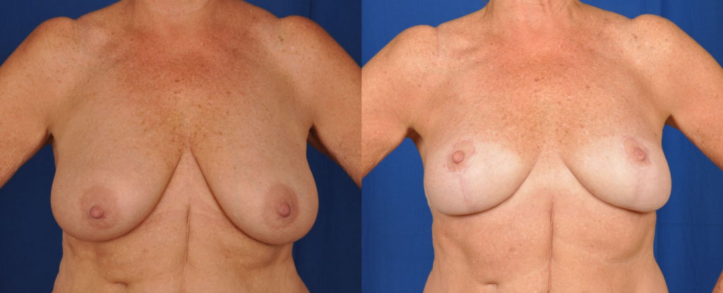 Breast reduction combined with breast lift results (front view).