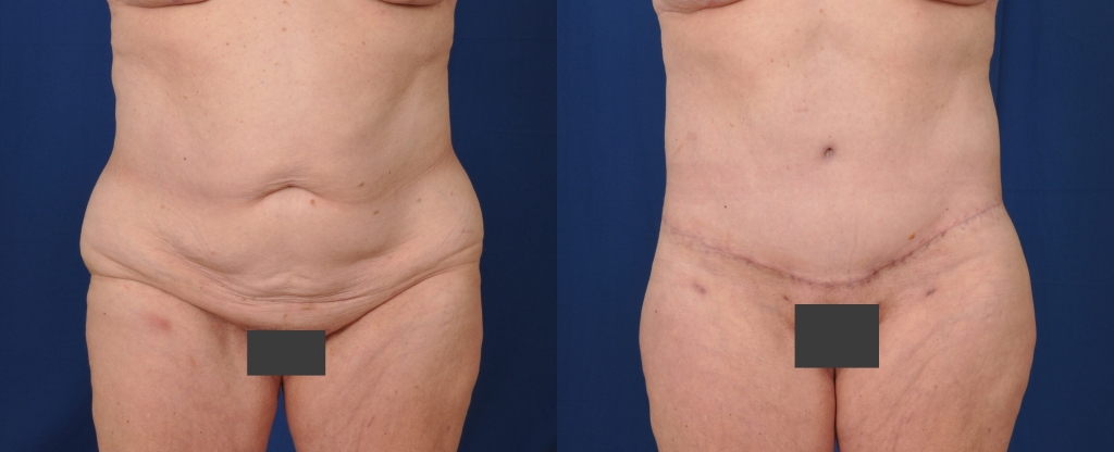 Before and after images of a lower body lift.
