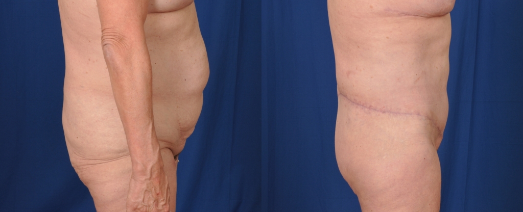 Before and after images of a lower body lift.