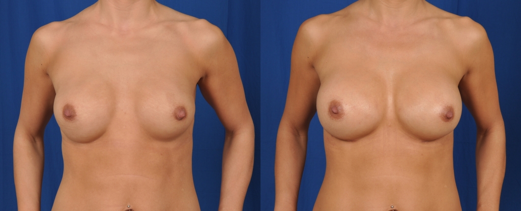 Before and after images of replacement of saline with gel breast implants.