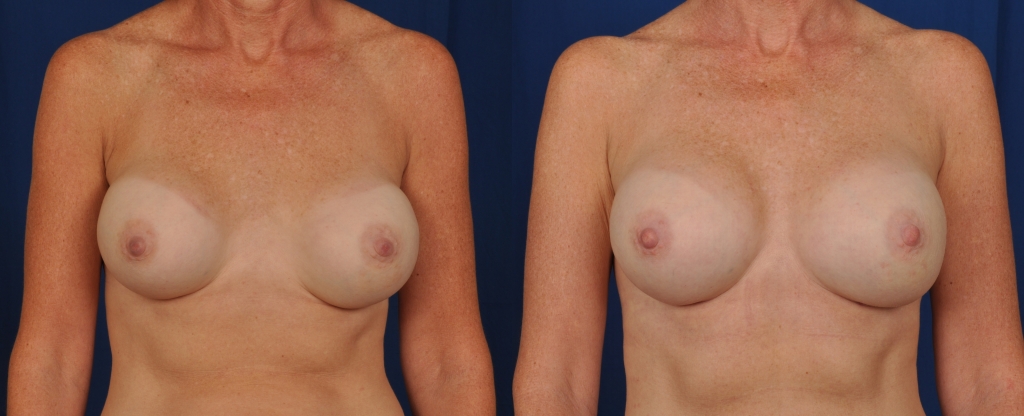 Before and after images of breast implant replacement.