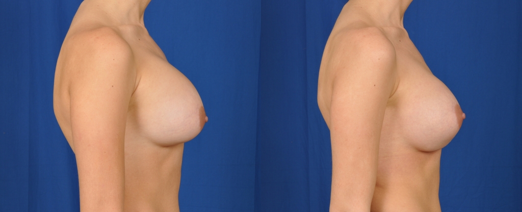 Before and after images of a right breast capsulotomy.