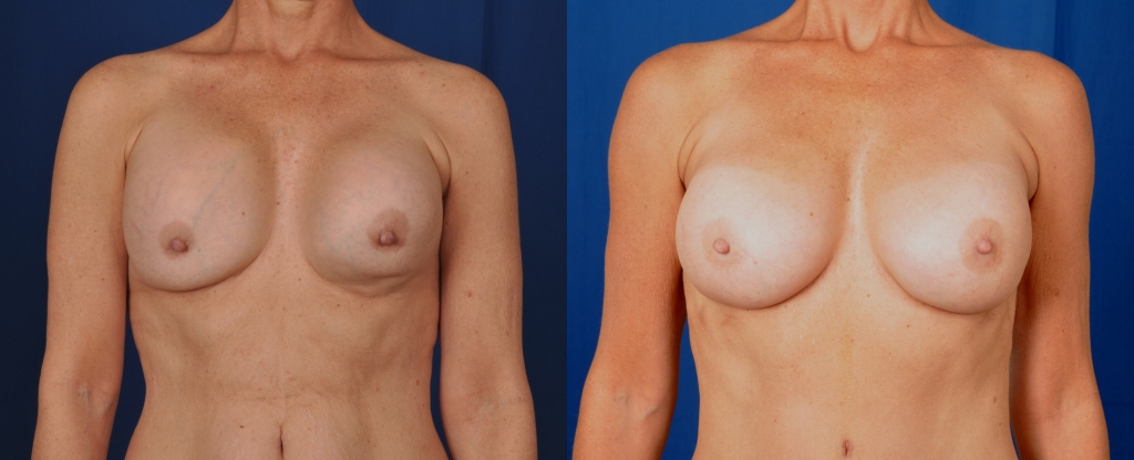 Before and after images of replacement of ruptured gel implants.