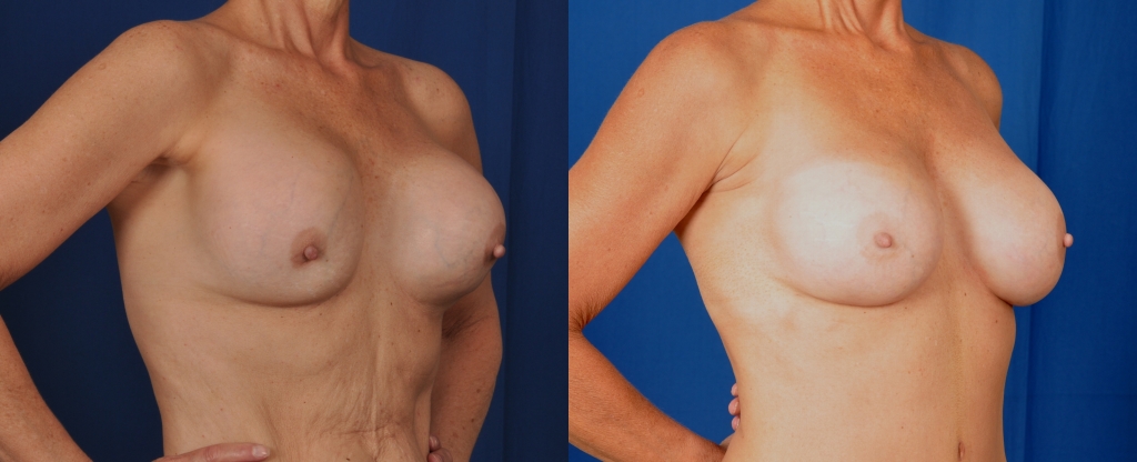 Before and after images of replacement of ruptured gel implants.