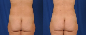 Before and after images of liposuction of muffin tops.