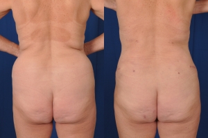 Before and after images of liposuction of the flanks.