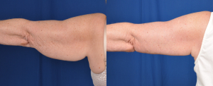 Brachioplasty results (left arm)