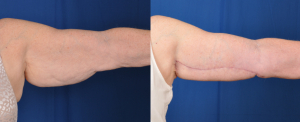 Brachioplasty results (right arm)