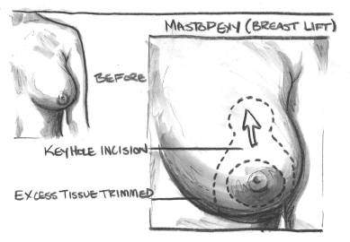 Drawing showing a breast lift keyhole incision.