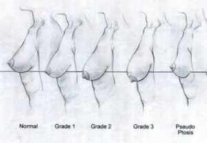 breast-ptosis-grades