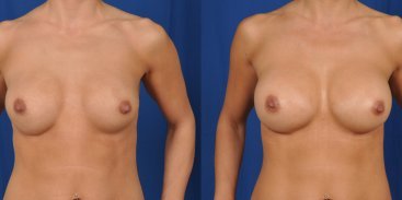 Breast Revision 1