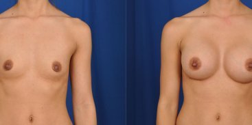 Breast Augmentation 14