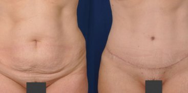 Abdominoplasty 5