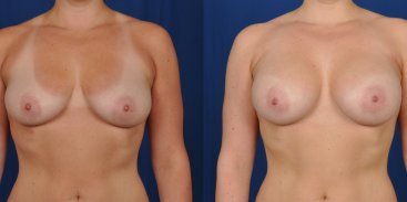 Breast Augmentation 15