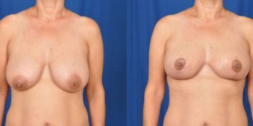 Breast Reduction and Lift 4