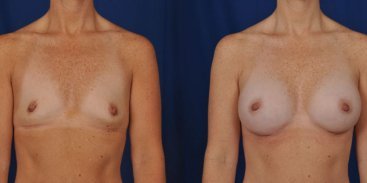 Breast Augmentation 1