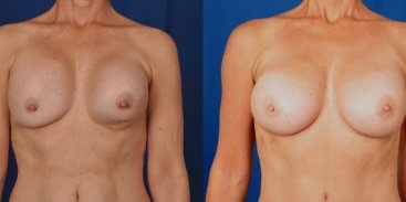 Breast Revision 9