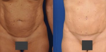 Abdominoplasty 8