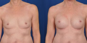 Breast Augmentation 2