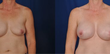 Breast Revision 3