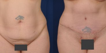 Abdominoplasty 2