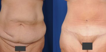 Abdominoplasty 4