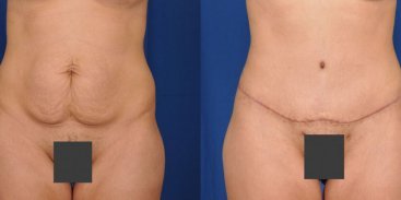 Abdominoplasty 1