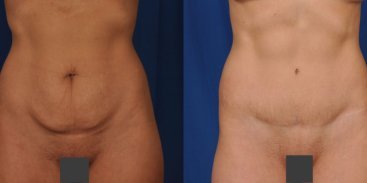 Abdominoplasty 9